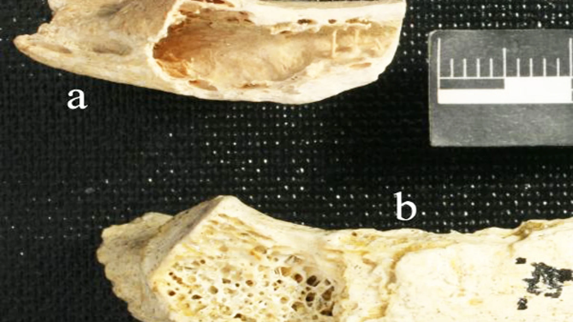 Arriba, el fragmento que sufrió el tumor, abajo un fragmento sano. Arriba, el fragmento que sufrió el tumor, abajo un fragmento sano.