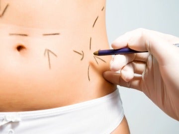 Liposucciones