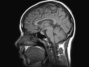 Imagen IRM de un escáner cerebral