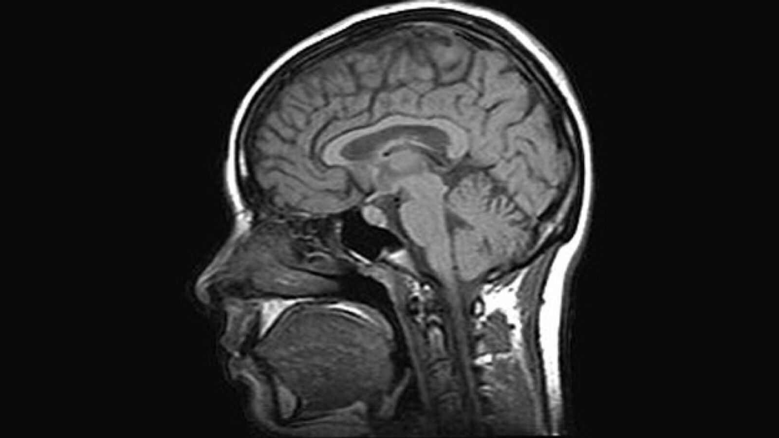Científicos españoles logran revertir la pérdida de memoria en casos precoces de Alzheimer