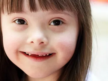 Niña con Síndrome de Down Niña con Síndrome de Down