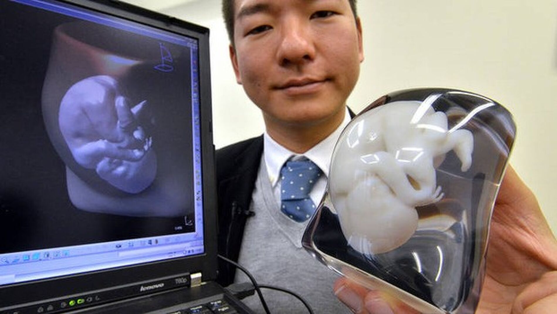 Imagen del modelo impreso en 3D de un feto, a partir de una ecograf&iacute;a