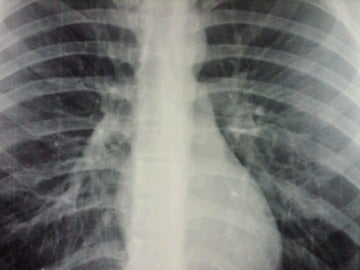 Radiografía Bronquiolitis Radiografía Bronquiolitis