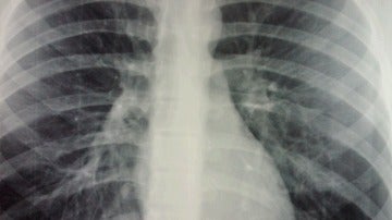 Radiografía Bronquiolitis