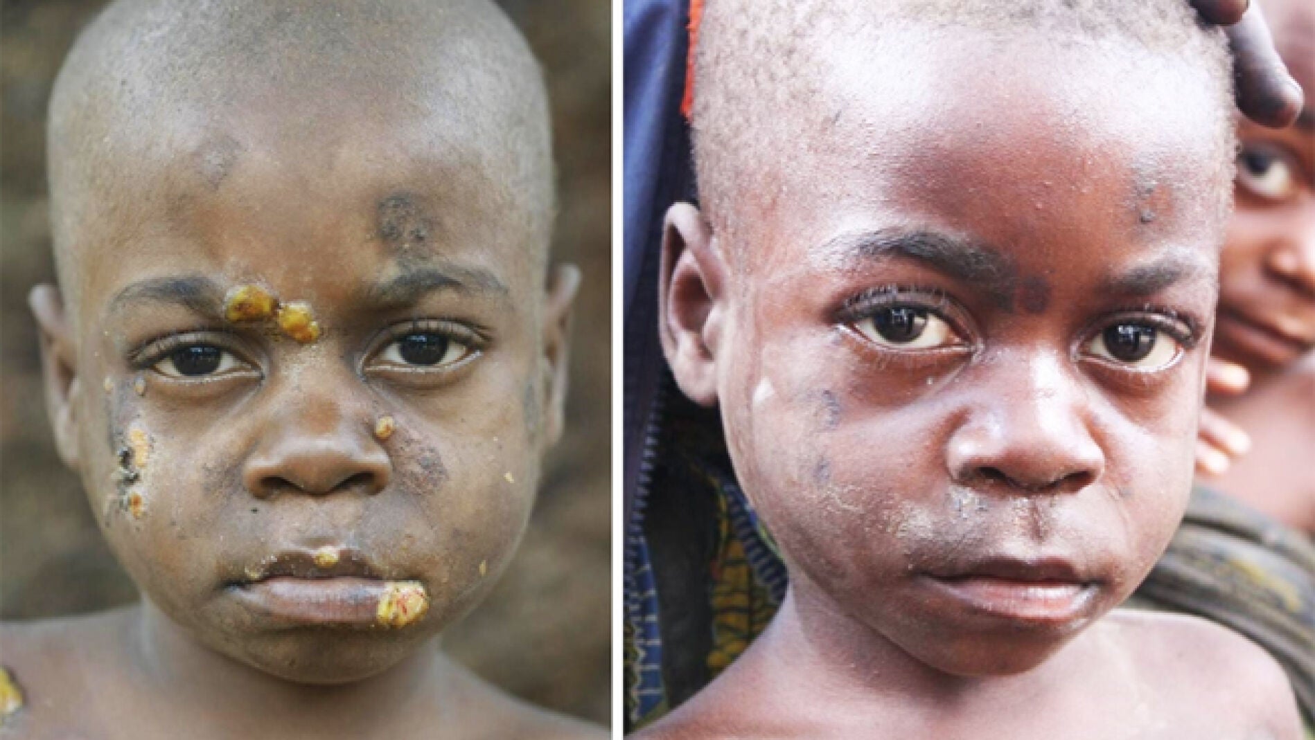 Un ni&ntilde;o aka, antes y despu&eacute;s del tratamiento contra el pian. 