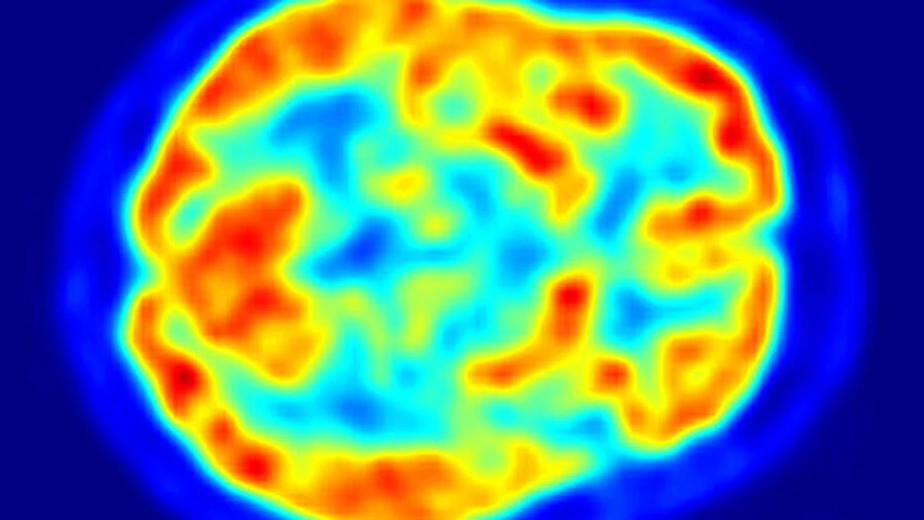 Un cerebro a través de un PET Un cerebro a través de un PET