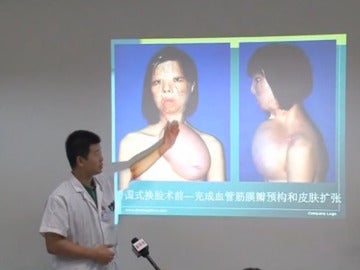 Una joven china recibe un trasplante de cara procedente de un injerto en su pecho Una joven china recibe un trasplante de cara procedente de un injerto en su pecho