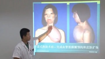 Una joven china recibe un trasplante de cara procedente de un injerto en su pecho