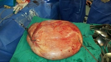 Un tumor de 25 kilos