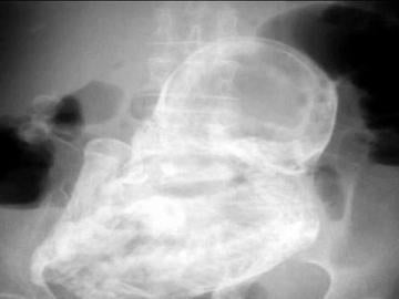 Una colombiana vive 40 años con un feto en su abdomen Una colombiana vive 40 años con un feto en su abdomen