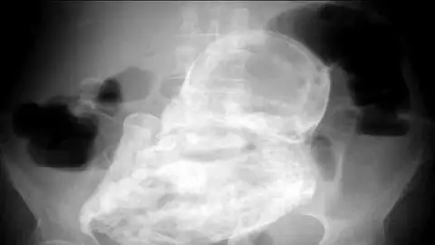 Una colombiana vive 40 años con un feto en su abdomen Una colombiana vive 40 años con un feto en su abdomen