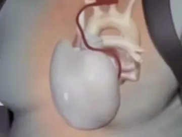 Corazón artificial Corazón artificial