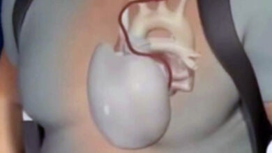 Éxito sin precedentes en trasplante de corazón artificial