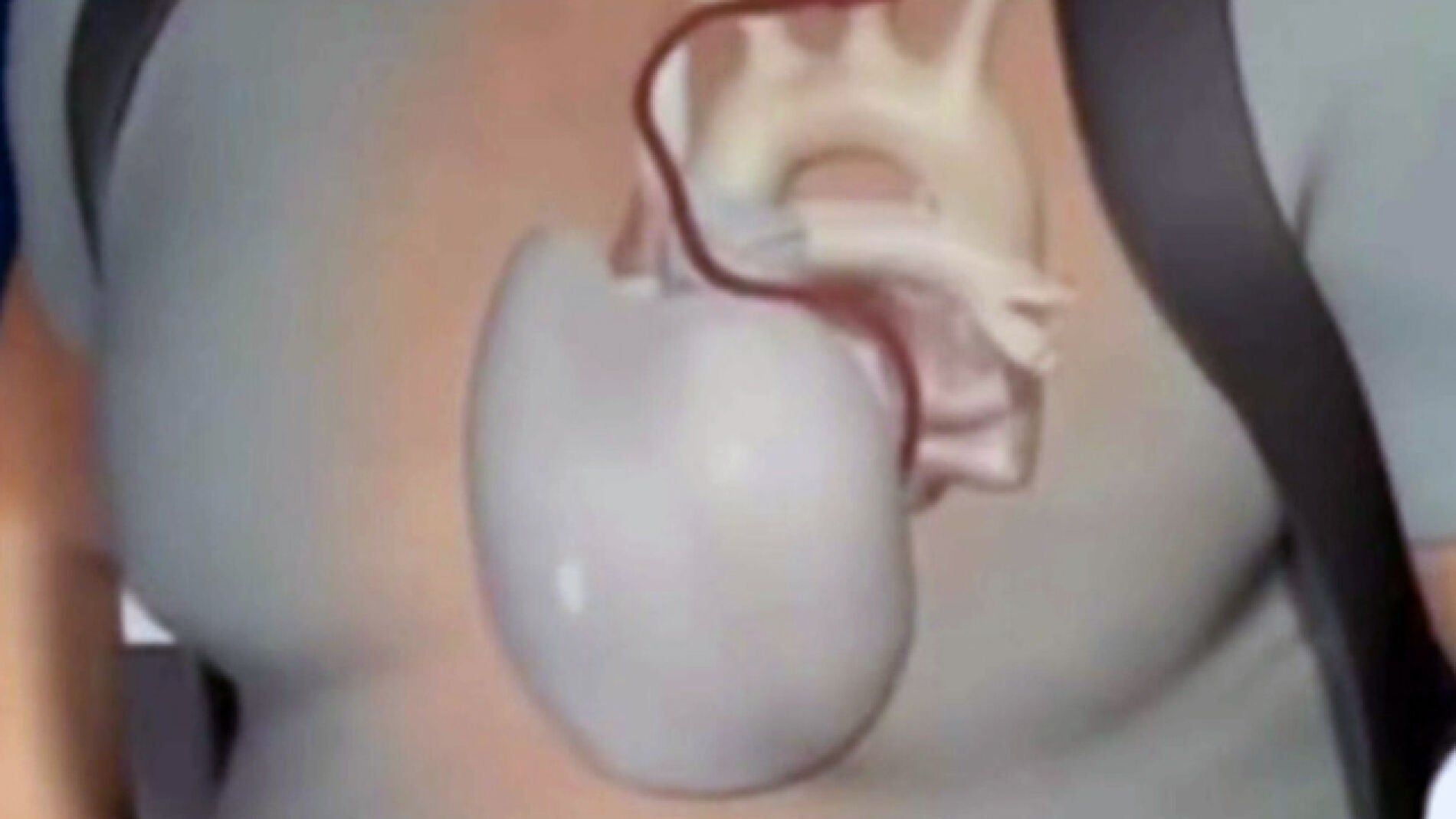 Coraz&oacute;n artificial