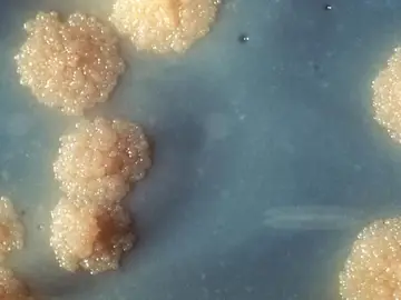 Tuberculosis Tuberculosis