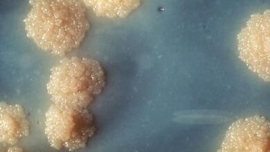 Día Mundial contra la Tuberculosis: La enfermedad mata a 5.000 personas cada día y más de cuatro millones de afectados están sin diagnóstico