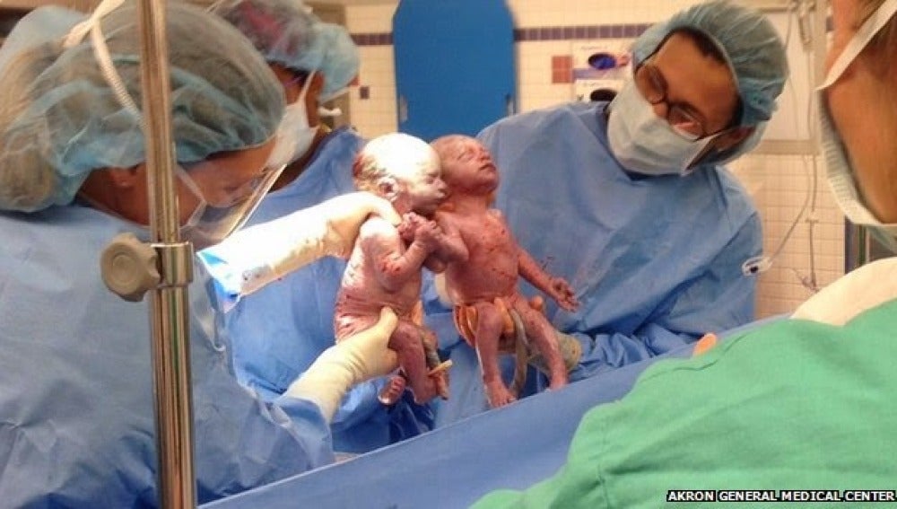 Dos gemelas idénticas nacen agarradas de la mano en Estados Unidos