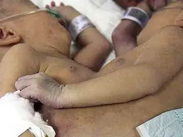 Siamesas unidas por el vientre Siamesas unidas por el vientre