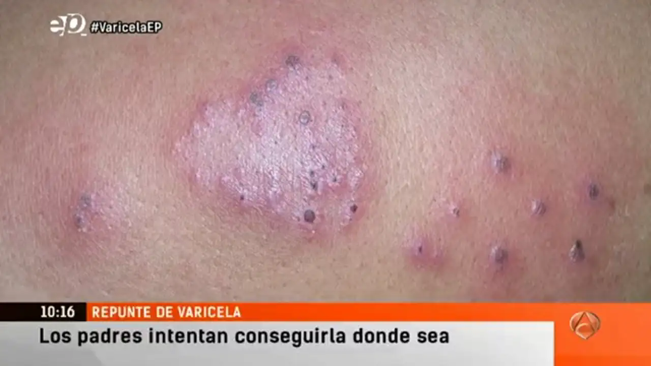 Crecen en un 16 por ciento los casos de varicela en España
