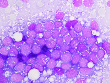 Una muestra de leucemia Una muestra de leucemia