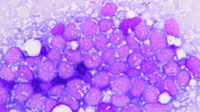 Descubren un fármaco contra la leucemia efectivo contra el cáncer de páncreas