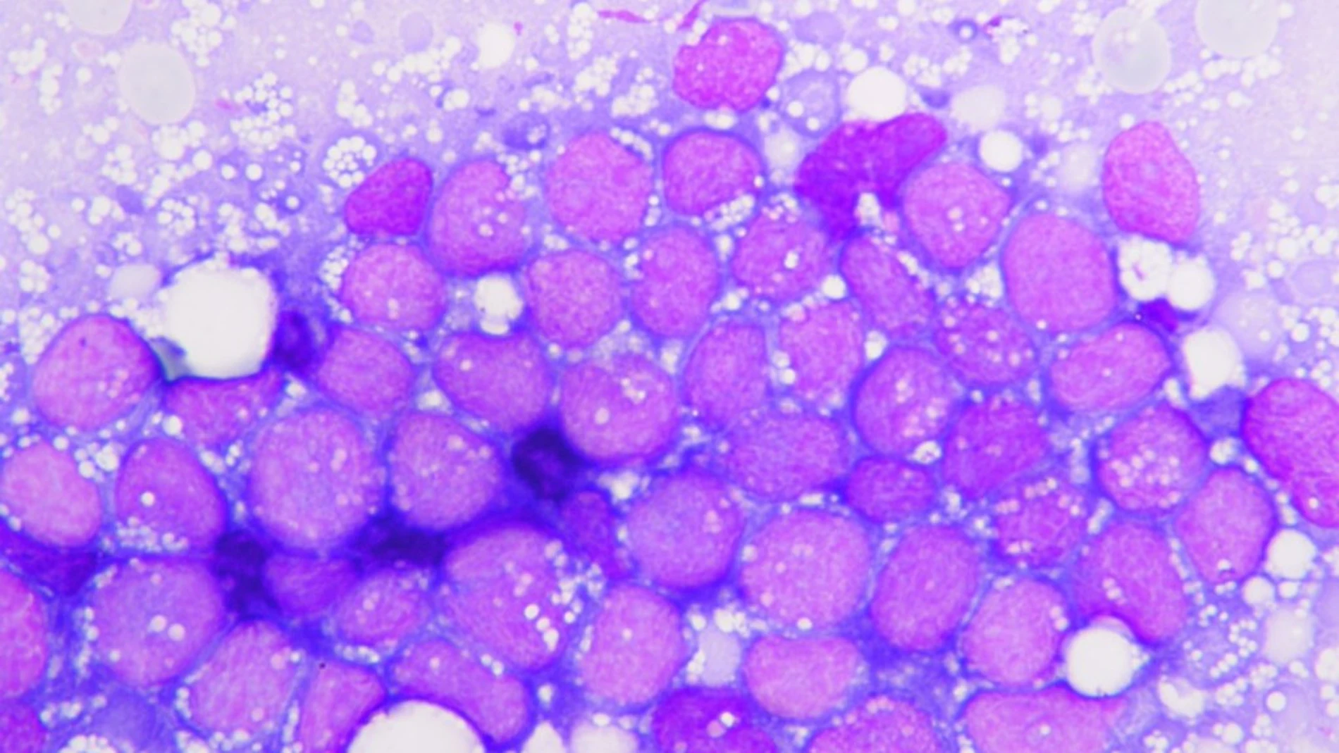 Una muestra de leucemia Una muestra de leucemia