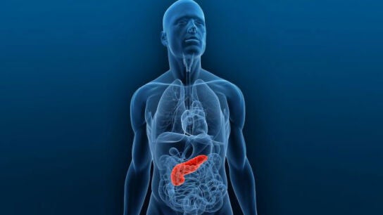 C&aacute;ncer de p&aacute;ncreas