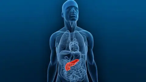 Cáncer de páncreas Cáncer de páncreas