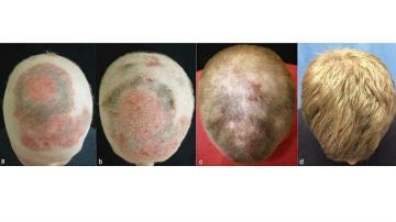 Proceso de crecimiento de pelo debido al tofacitinib