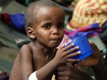 Niño afectado por la crisis alimentaria en Somalia