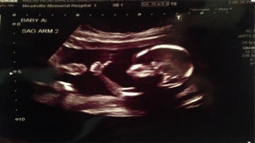 Ecografía de un bebé de 16 semanas con el pulgar hacia arriba.
