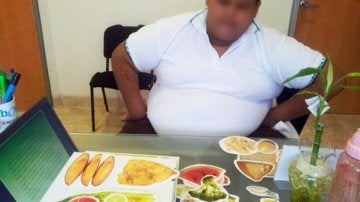 Realizan en México bypass gástrico a un menor que pesaba 191 kilos