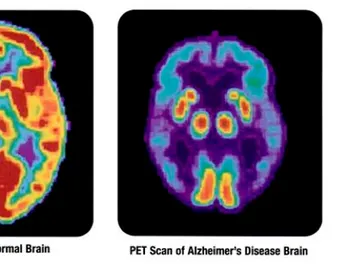 Alzheimer Alzheimer