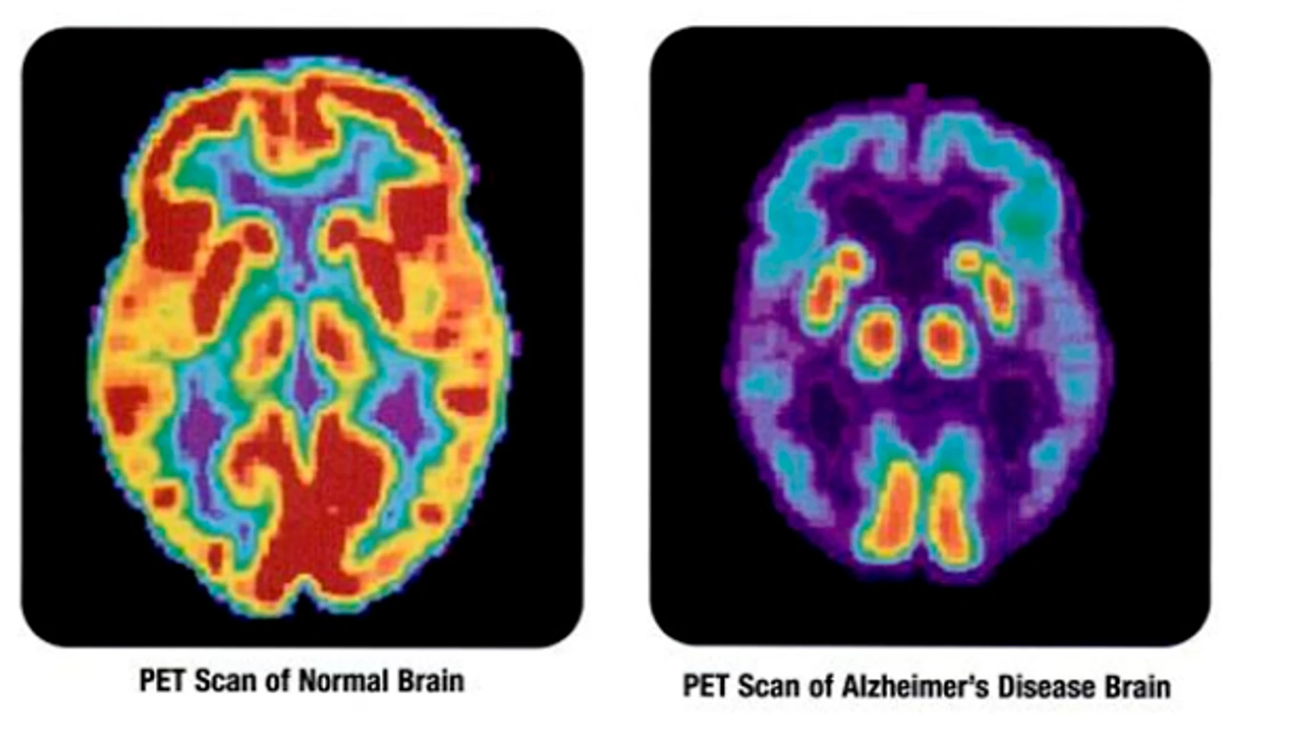 Alzheimer Alzheimer