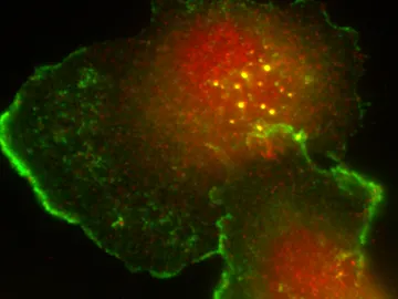 Células tumorales humanas de cáncer de m Células tumorales humanas de cáncer de m