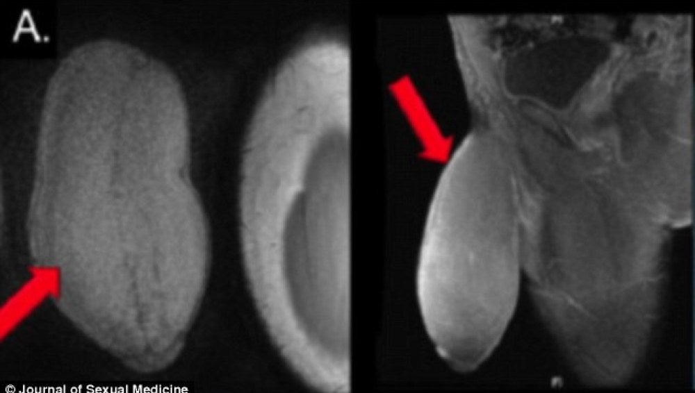 Radiografías del pene del paciente publicadas por 'Journal of Sexual Medicine'.