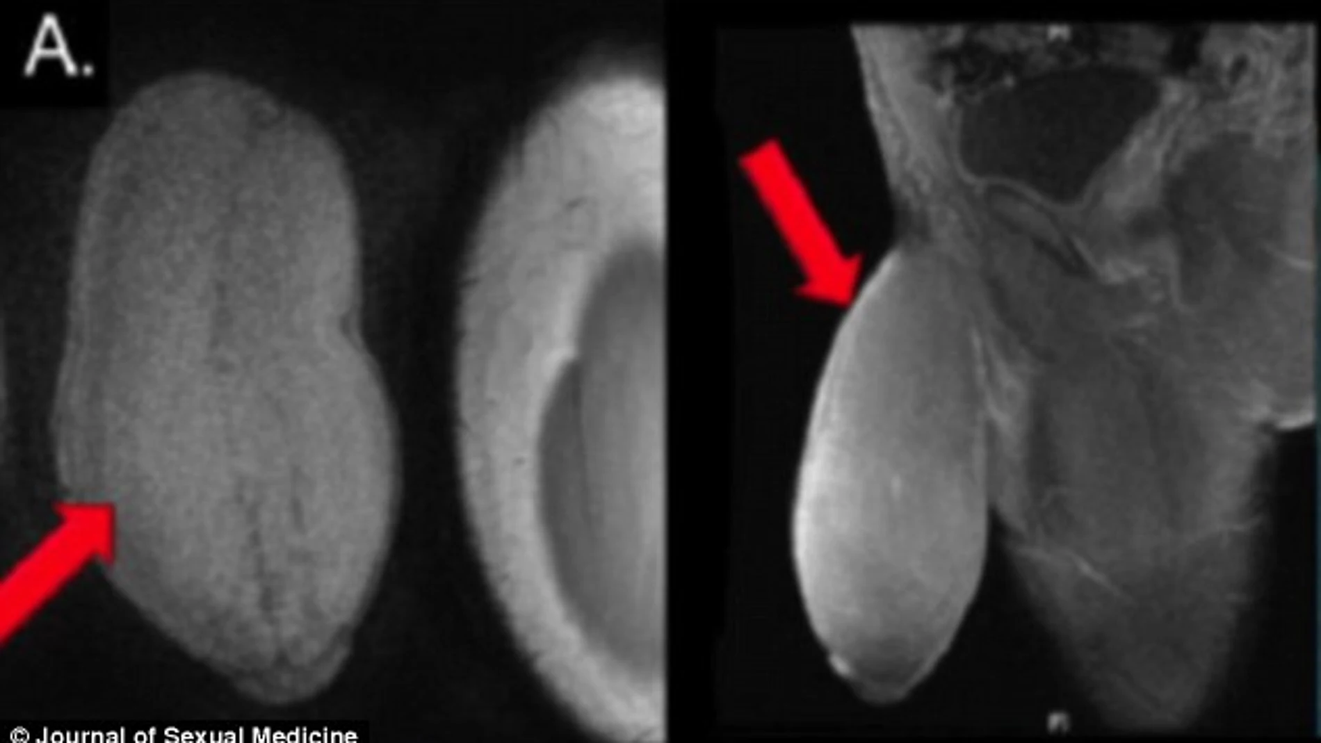 Radiografías del pene del paciente publicadas por 'Journal of Sexual Medicine'. Radiografías del pene del paciente publicadas por 'Journal of Sexual Medicine'.
