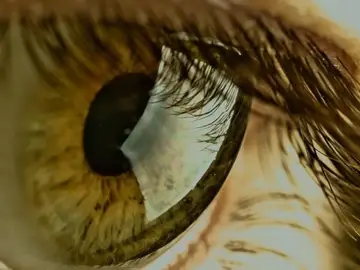 Células madre de la pulpa dental pueden transformarse para tratar cicatrices en la córnea Células madre de la pulpa dental pueden transformarse para tratar cicatrices en la córnea