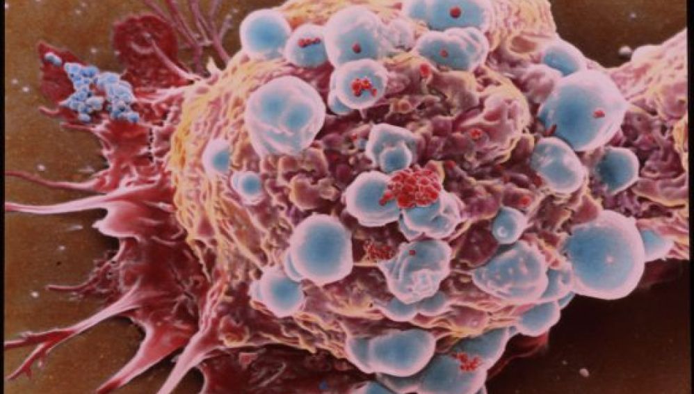Célula cancerosa de cáncer de mama