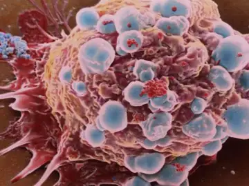 Célula cancerosa de cáncer de mama Célula cancerosa de cáncer de mama