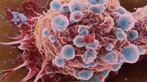 C&eacute;lula cancerosa