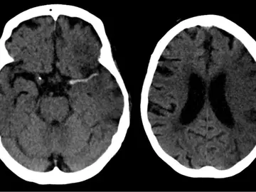Ictus en arteria cerebral media (izda) y evolución a las 7 horas (dcha). Ictus en arteria cerebral media (izda) y evolución a las 7 horas (dcha).