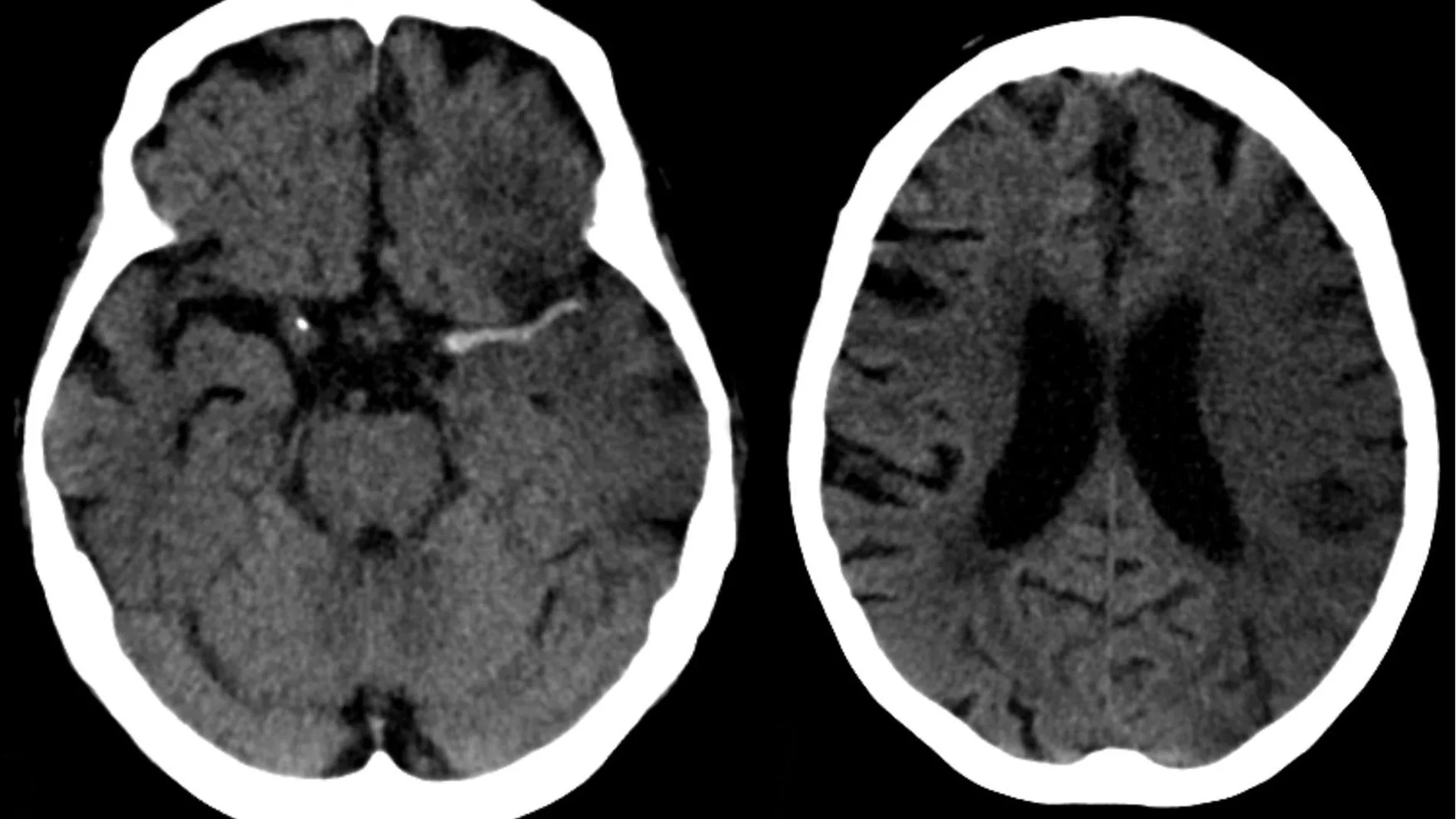 Ictus en arteria cerebral media (izda) y evolución a las 7 horas (dcha). Ictus en arteria cerebral media (izda) y evolución a las 7 horas (dcha).