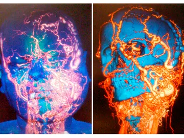Trasplante de cara en el Vall d'Hebron Trasplante de cara en el Vall d'Hebron