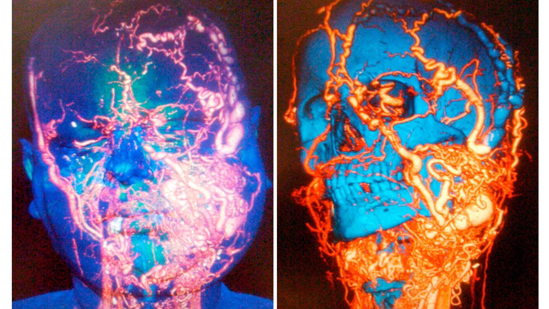 Trasplante de cara en el Vall d'Hebron