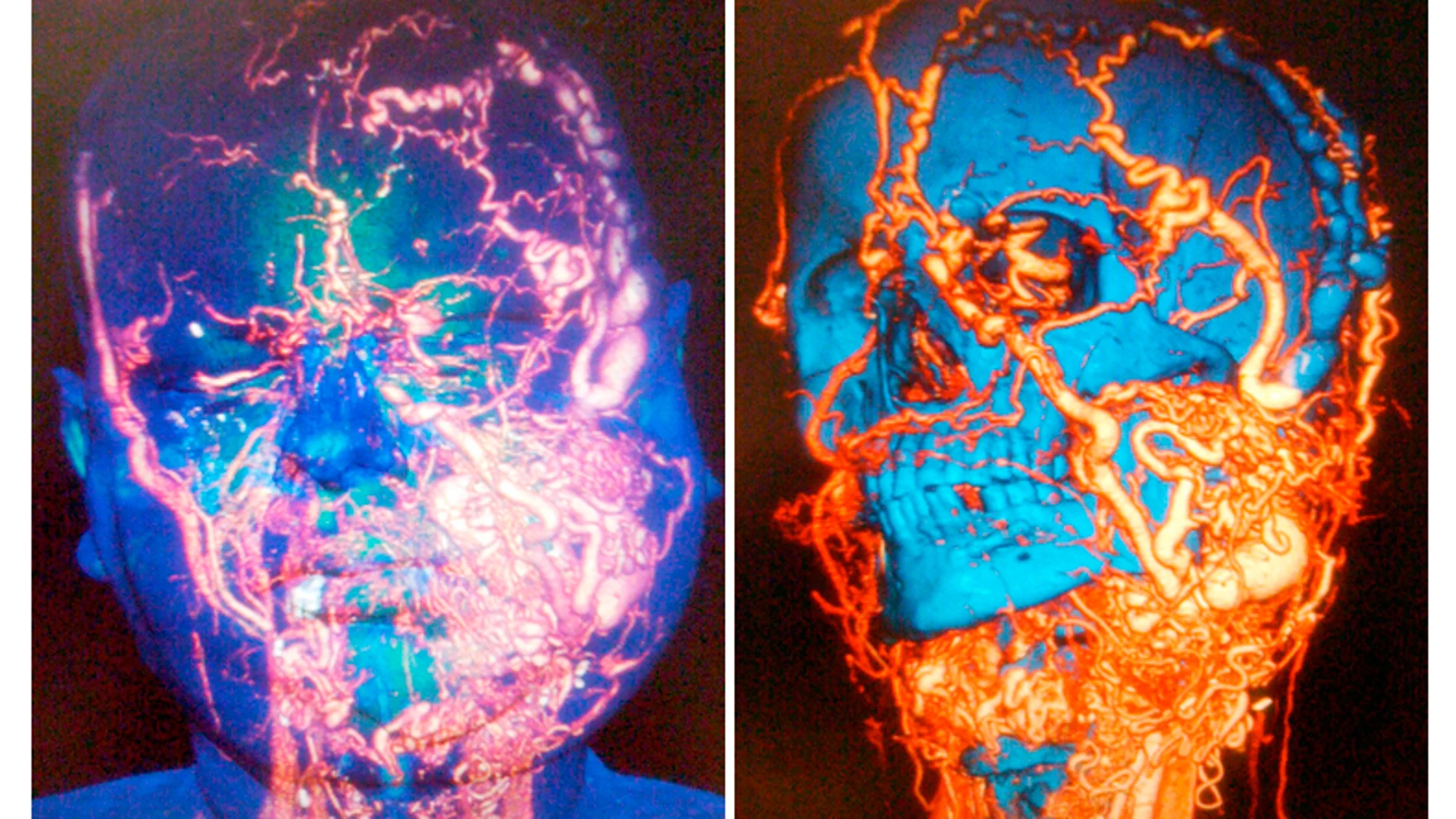 Trasplante de cara en el Vall d'Hebron Trasplante de cara en el Vall d'Hebron