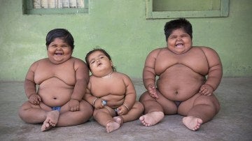Los tres niños indios con obesidad mórbida