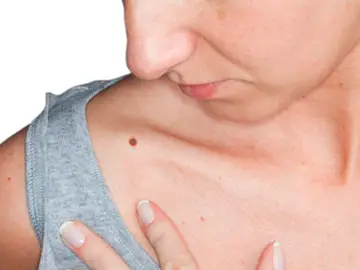 Cáncer de piel Cáncer de piel
