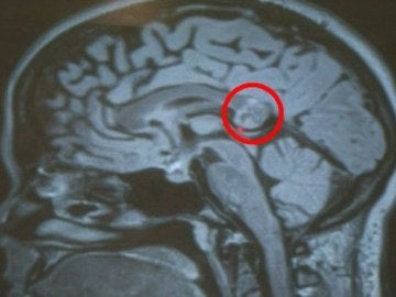 Descubrieron que el tumor era en realidad un teratoma Descubrieron que el tumor era en realidad un teratoma