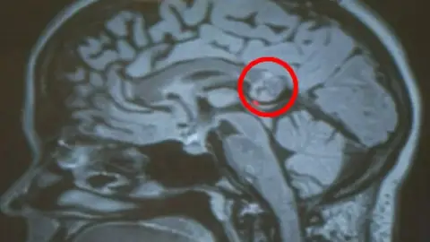 Descubrieron que el tumor era en realidad un teratoma Descubrieron que el tumor era en realidad un teratoma